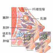 得了乳腺纤维瘤不能吃什么